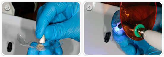 Help for the Insertion of the Pediatric crowns - Better fitting of crowns with flow komposite Step 3 and 4