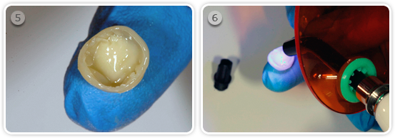 Unterfüttern der Kronen mit Flow Komposite Schritt 5 und 6