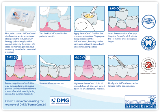 Implanting KidCadCrowns® 2.0